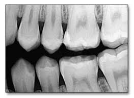 Appareil de radiographie dentaire - Un peu d’histoire