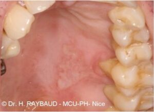 Appareil orthodontique dent acérée brûlure - Les douleurs orales d’autres origines