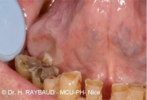 Appareil orthodontique dent acérée brûlure - Les douleurs orales d’autres origines