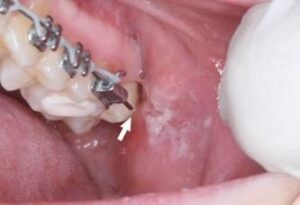 Appareil orthodontique dent acérée brûlure - Les douleurs orales d’autres origines
