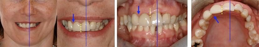 Asymétrie et déviation de la ligne médiane - Embellir son sourire ou une dent fragilisée