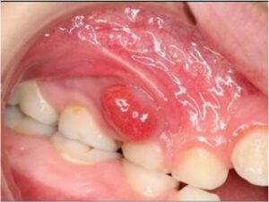 Blessures superficielles d’origine traumatique - Les douleurs orales d’autres origines