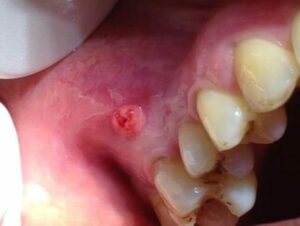 Blessures superficielles d’origine traumatique - Les douleurs orales d’autres origines