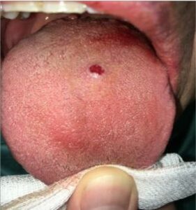 Botryomycome buccal (granulome pyogénique ou hémangiome lobulé) - Les douleurs orales d’autres origines