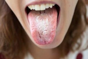Candidose - Les douleurs orales d’autres origines