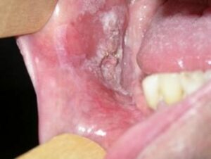 Carcinomes épidermoïdes ou spinocellulaire - Les douleurs orales d’autres origines