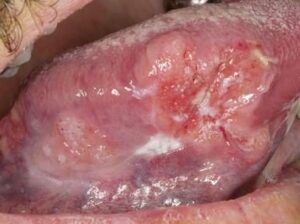 Carcinomes épidermoïdes ou spinocellulaire - Les douleurs orales d’autres origines