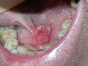 Carcinomes épidermoïdes ou spinocellulaire - Les douleurs orales d’autres origines