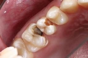 Caries vestibulaires des incisives Caries proximales Carie proximale débutante Carie occlusale - Les taches brunes et no