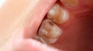 Caries vestibulaires des incisives Caries proximales Carie proximale débutante Carie occlusale - Les taches brunes et no