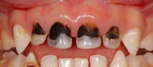 Caries vestibulaires des incisives Caries proximales Carie proximale débutante Carie occlusale - Les taches brunes et no