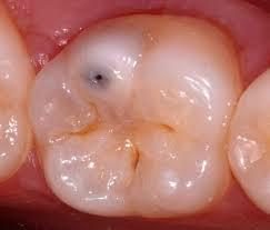 Caries vestibulaires des incisives Caries proximales Carie proximale débutante Carie occlusale - Les taches brunes et no