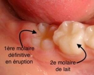 Causes apparues durant la grossesse ou la petite enfance - Présence de taches blanches
