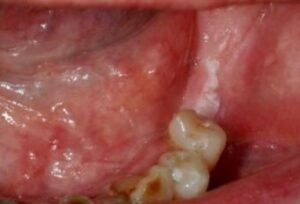 Dent qui coupe Morsure de dent antagoniste Pastille pour la gorge Chewing-gum - Les douleurs orales d’autres origines