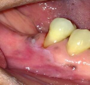 Dent qui coupe Morsure de dent antagoniste Pastille pour la gorge Chewing-gum - Les douleurs orales d’autres origines
