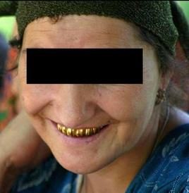 Dents limées «Ohaguro » noircissement des dents couverture dorée (Europe de l’est / Moyen-Orient) - Un peu d’histoire