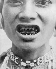 Dents limées «Ohaguro » noircissement des dents couverture dorée (Europe de l’est / Moyen-Orient) - Un peu d’histoire