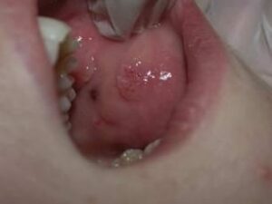 Différentes formes d’angiome lymphangiome - Les douleurs orales d’autres origines