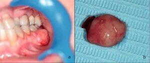 Fibrome cémato-ossifiant ou périphérique - Les douleurs orales d’autres origines