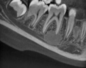 Fibrome cémato-ossifiant ou périphérique - Les douleurs orales d’autres origines