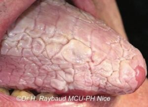 forme réticulée forme papuleuse forme en plaque - Les douleurs orales d’autres origines