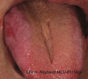 formes atrophiées gingivite desquamative/ lichen plan érosif - Les douleurs orales d’autres origines