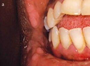 Hyperplasie épithéliale focale ou syndrome de Heck - Les douleurs orales d’autres origines