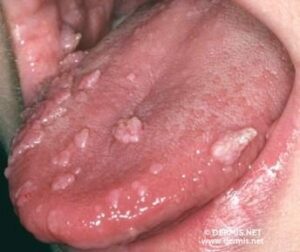 Hyperplasie épithéliale focale ou syndrome de Heck - Les douleurs orales d’autres origines