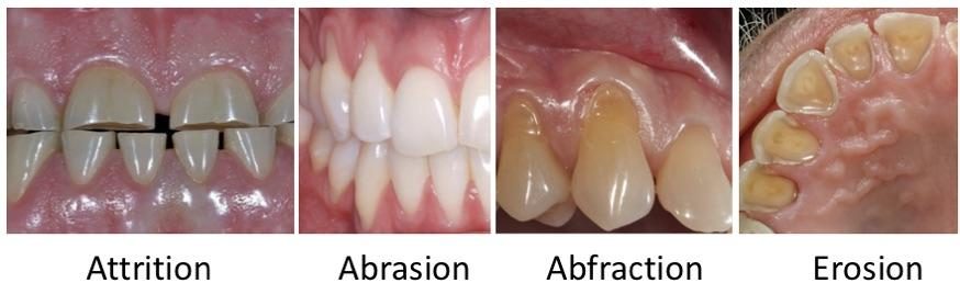 Il existe différente forme d’usure - Les taches brunes et noires