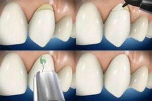 Il existe différente forme d’usure - Les taches brunes et noires