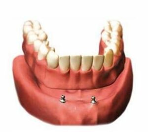Inconvénients - Perte des dents : comment y remédier ?