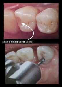 Inconvénients - Perte des dents : comment y remédier ?