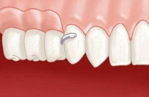Inconvénients - Perte des dents : comment y remédier ?
