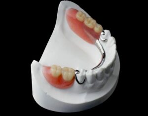 Inconvénients - Perte des dents : comment y remédier ?