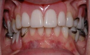 Inconvénients - Perte des dents : comment y remédier ?