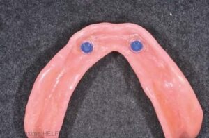 Inconvénients - Perte des dents : comment y remédier ?
