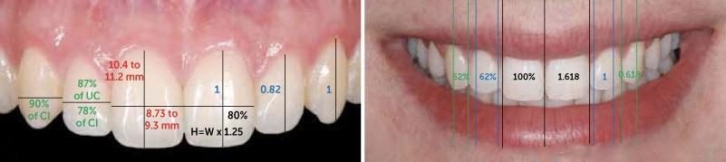 La beauté des dents sur mesure : le secret de l’harmonie - Embellir son sourire ou une dent fragilisée