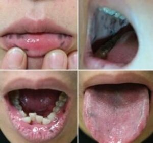 La mélanose essentielle ou syndrome de Laugier-Hunziker - Les douleurs orales d’autres origines
