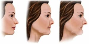 La prothèse complète - Perte des dents : comment y remédier ?