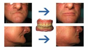 La prothèse complète - Perte des dents : comment y remédier ?