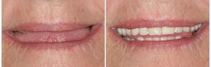 La prothèse complète - Perte des dents : comment y remédier ?