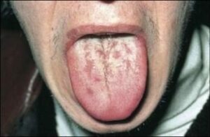 La syphilis - Les douleurs orales d’autres origines
