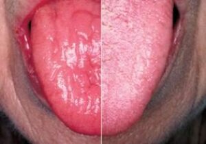 langue atteinte langue normale - Les pathologies médicales et les influences de la cavité buccale