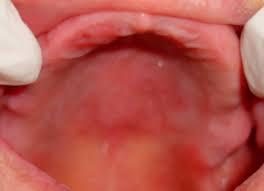 langue atteinte langue normale - Les pathologies médicales et les influences de la cavité buccale