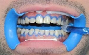 Le blanchiment au fauteuil - Embellir son sourire ou une dent fragilisée