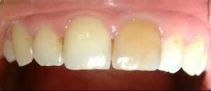 Le blanchiment interne des dents dévitalisées - Embellir son sourire ou une dent fragilisée
