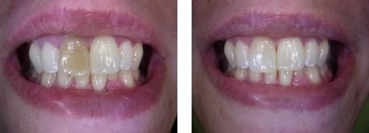 Le blanchiment interne des dents dévitalisées - Embellir son sourire ou une dent fragilisée