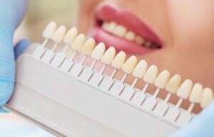 Le blanchiment par gouttière - Embellir son sourire ou une dent fragilisée
