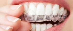 Le blanchiment par gouttière - Embellir son sourire ou une dent fragilisée