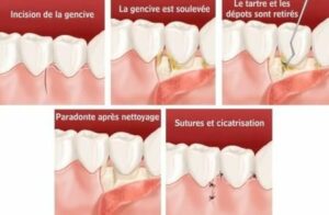 Le diagnostic - La gingivite, la parodontite, le détartrage